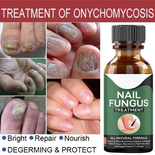 Nail Fungal Treatments