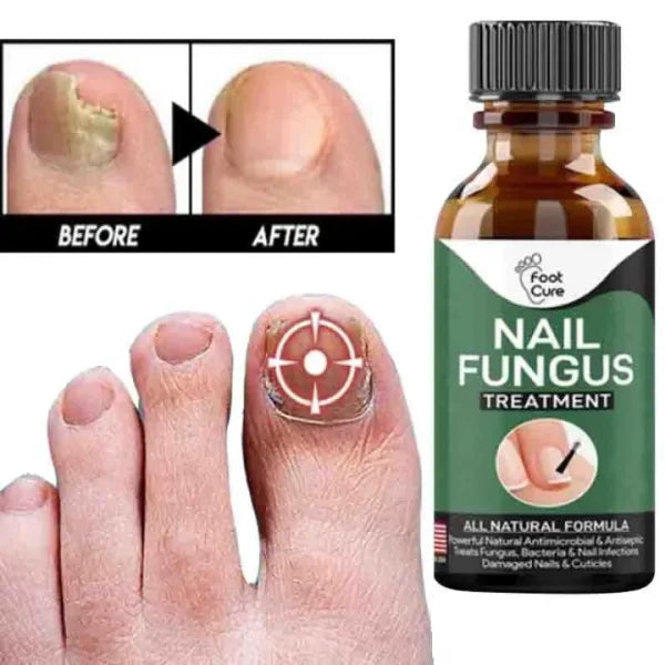 Nail Fungal Treatments